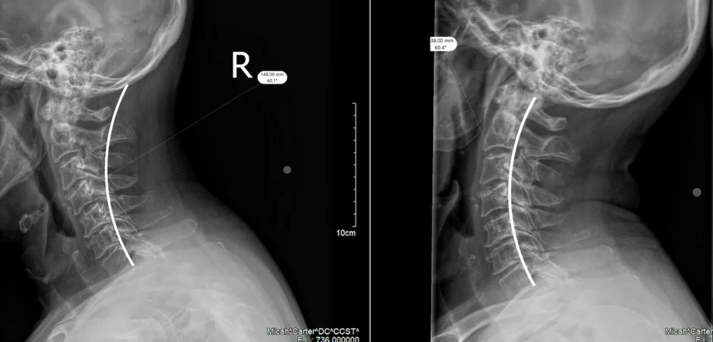 Neck-curvature-before-and-after-xrays-chiropractic