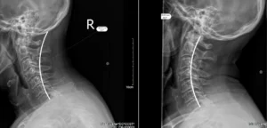 Neck-curvature-before-and-after-xrays-chiropractic