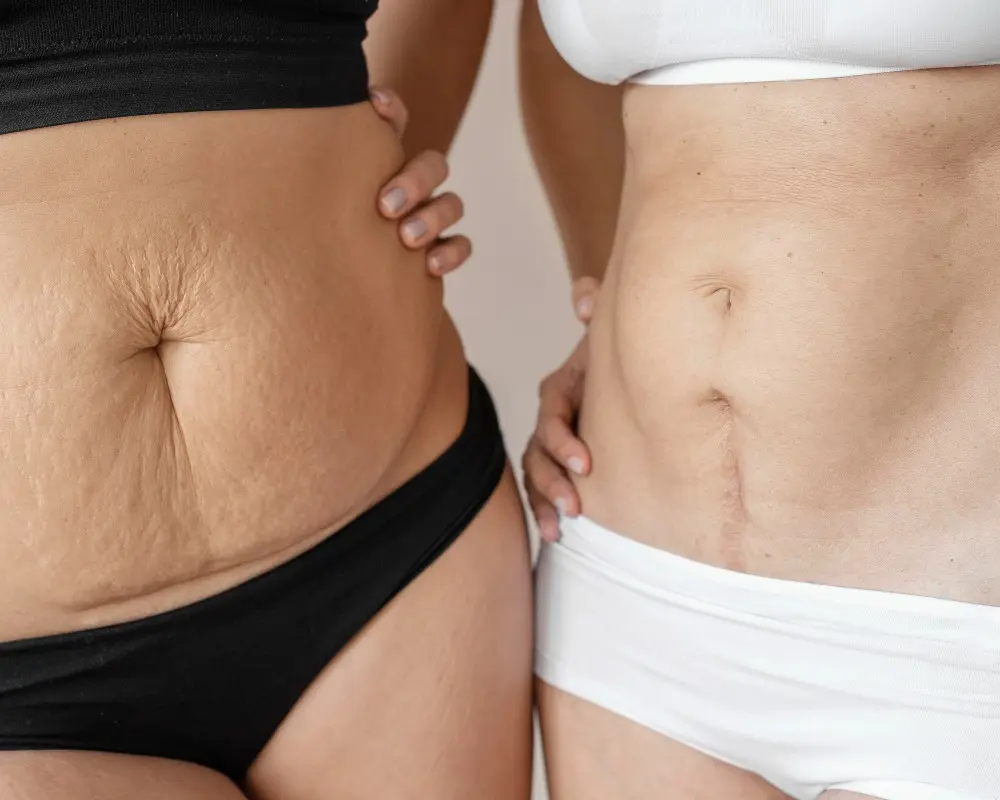 Two females close up body fat loose skin